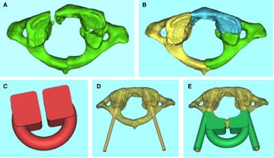 Individualized 3D printed navigation template-assisted atlantoaxial pedicle screws vs. free-hand screws for the treatment of upper cervical fractures